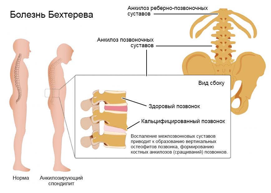 Боль в спине: как отличить остеохондроз от болезни Бехтерева